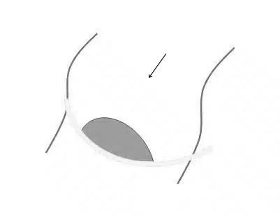 Conventional floating weed and debris boom installation showing central collection area in slow to moderate moving water